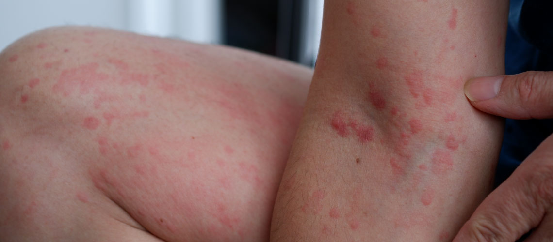 Urticária crónica: diagnóstico, subtipos e avanços no tratamento
