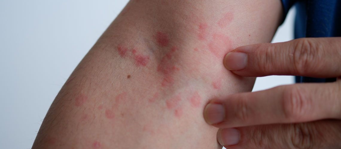 Urticária em foco: como diferenciar e tratar